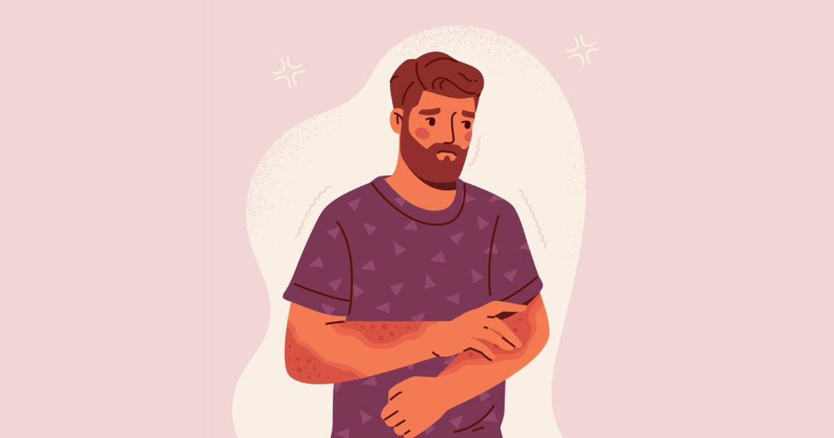 Medical Cannabis for Psoriasis Symptoms