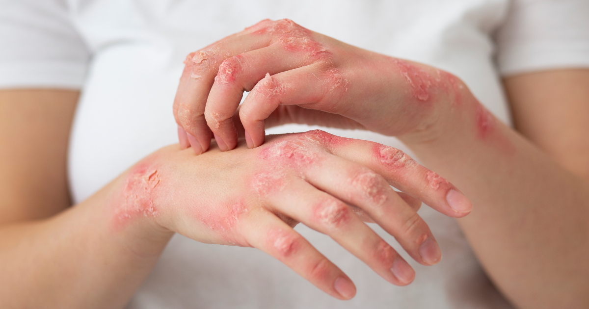 Medical Marijuana for Eczema